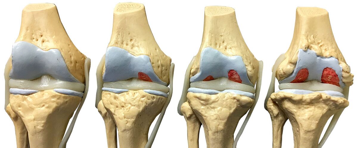 Mga yugto ng arthrosis