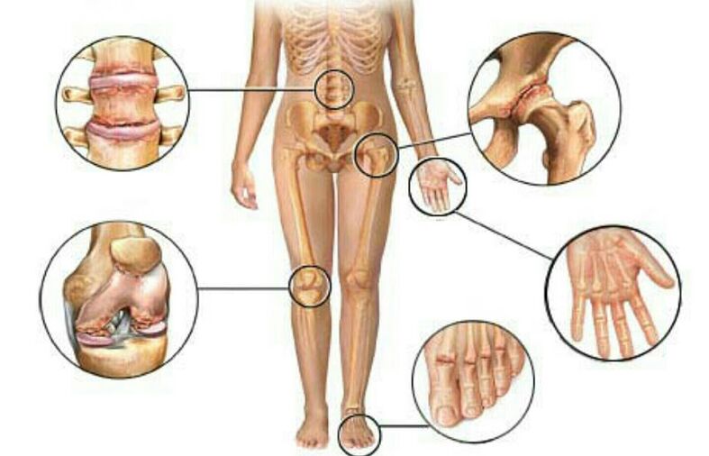 mga uri at antas ng arthrosis